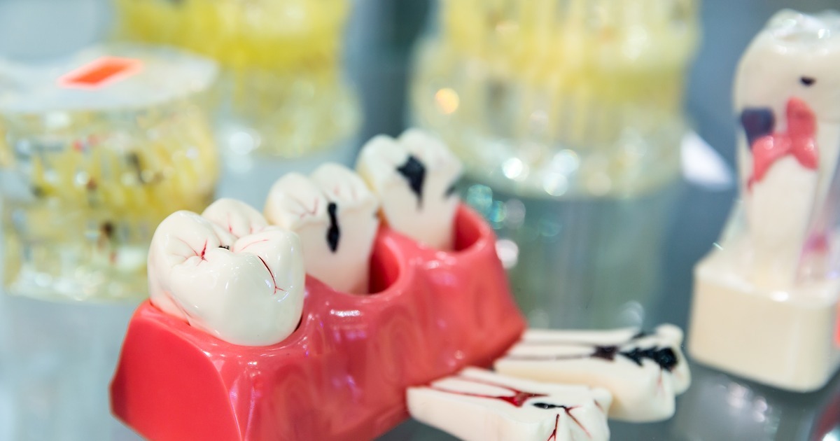 tooth decay