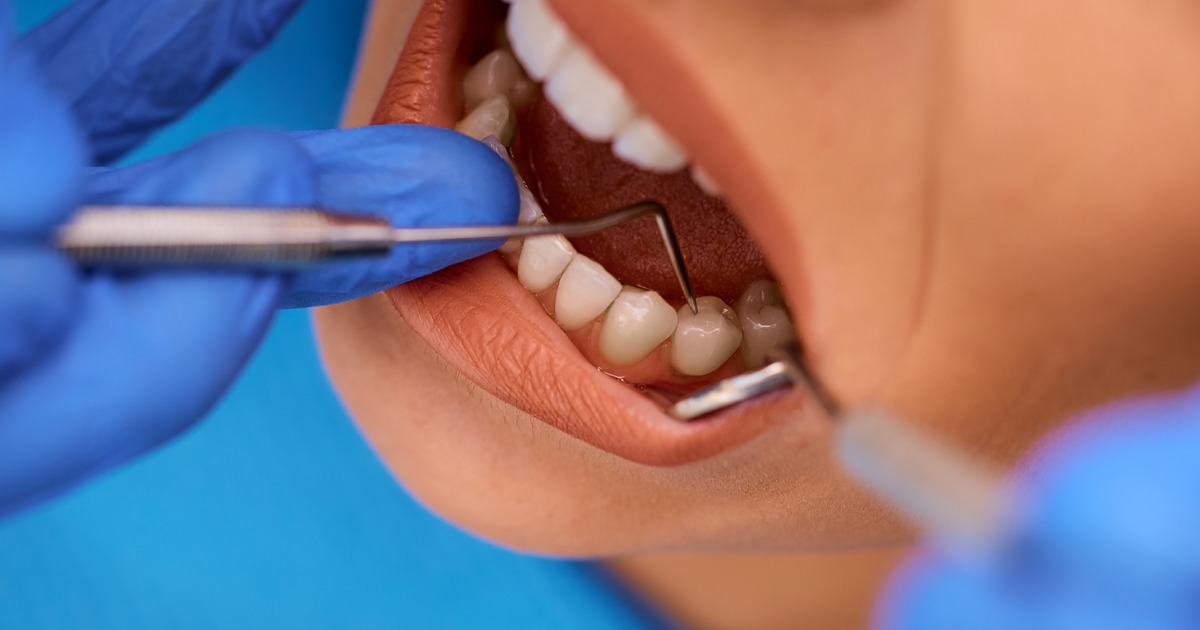 How Long Does It Take for Periodontitis to Develop