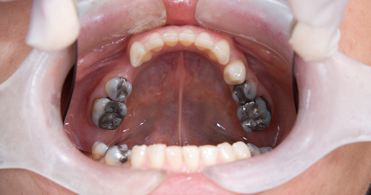 grey spot on teeth