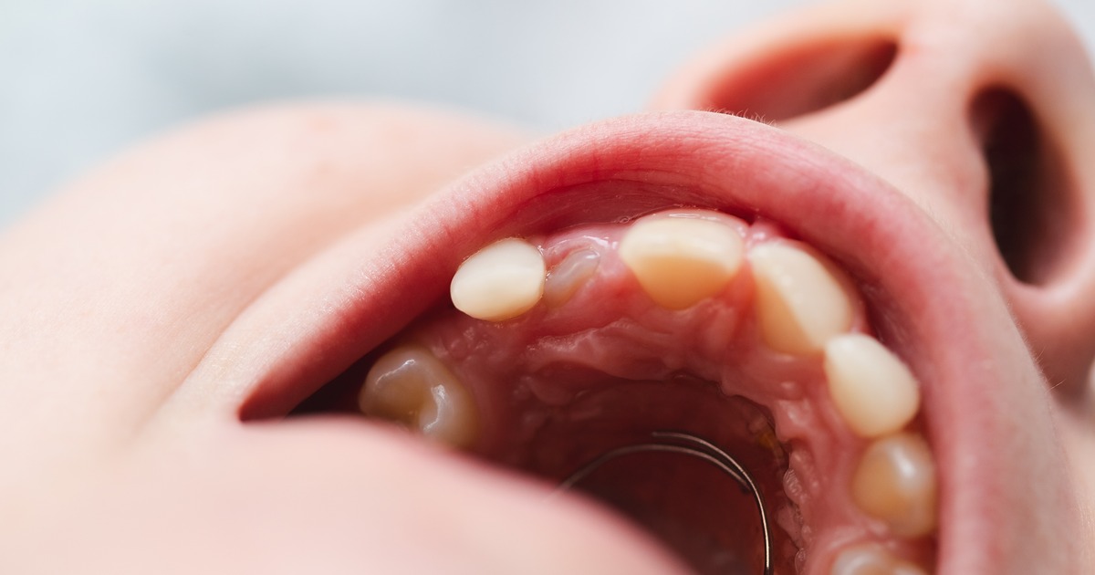 teeth rotting inside