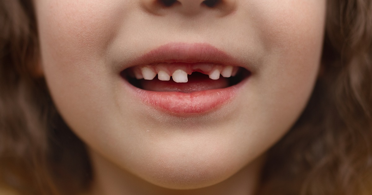 kid tooth decay