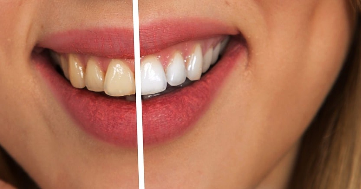 before and after dental cleaning